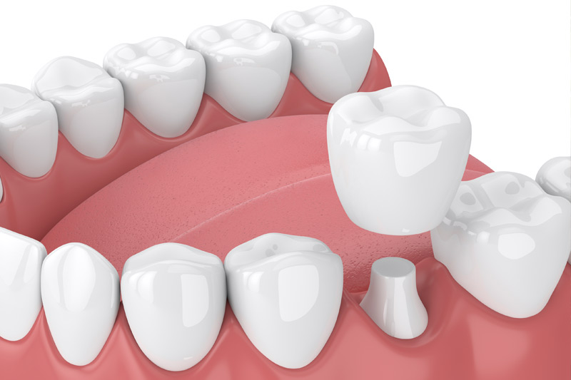 Dental Crowns in Doylestown & Bucks County