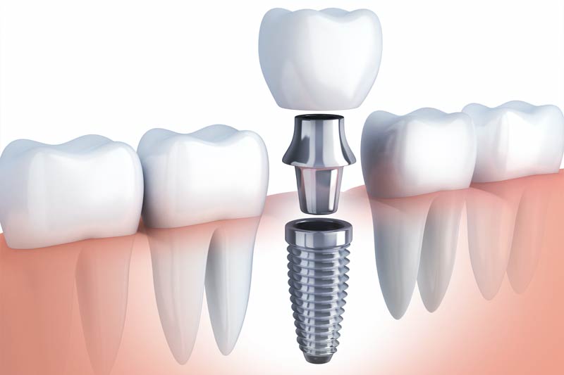 Implants Dentist in Doylestown & Bucks County